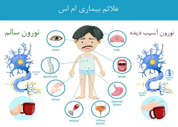 علایم بیماری ام اس