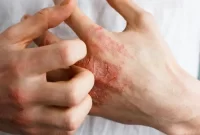 شایع ترین بیماری های پوستی و علائم آنها