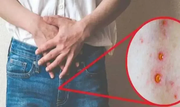 بیماری سیفلیس