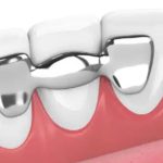 بریج دندان بدون تراش چیست؟ آشنایی با فواید و عوارض آن