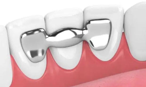 بریج دندان بدون تراش چیست؟ آشنایی با فواید و عوارض آن