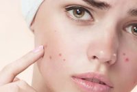 لک صورت نشانه چیست؟  بهترین روش های درمان