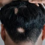 آلوپسی آره آتا (Alopecia Areata) چیست؟ علت، علائم و راه‌های درمان آن