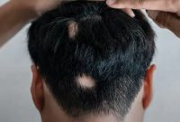 آلوپسی آره آتا (Alopecia Areata) چیست؟ علت، علائم و راه‌های درمان آن