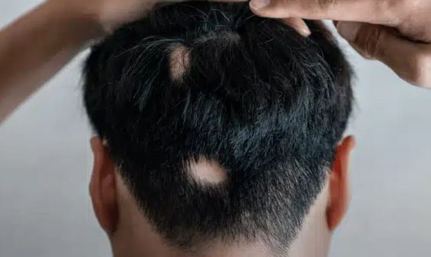 آلوپسی آره آتا (Alopecia Areata) چیست؟ علت، علائم و راه‌های درمان آن