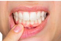 تحلیل لثه چه علائمی دارد؟