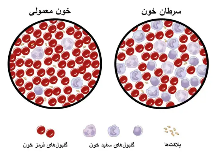 درمان سرطان خون