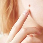 skin-mole (1)