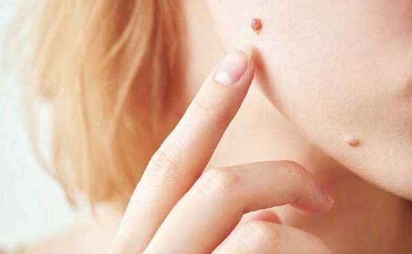 skin mole 1