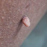 vaginal-skin-tag (1)