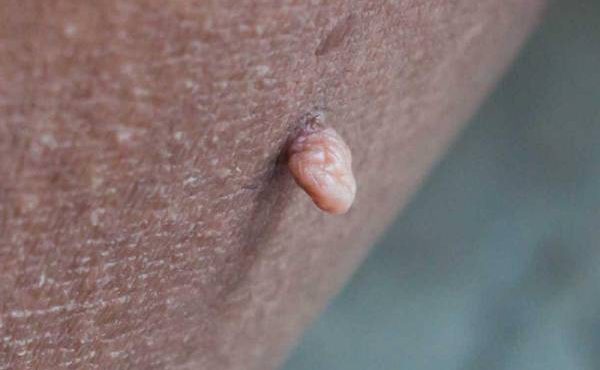 vaginal skin tag 1