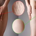 بیماری سلولیت