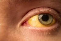 بیماری تب زرد | علائم، علل و درمان بیماری تب زرد | علائم، علل و درمان