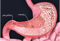 زخم معده و علائم آن