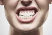 دندان قروچه(Bruxism)