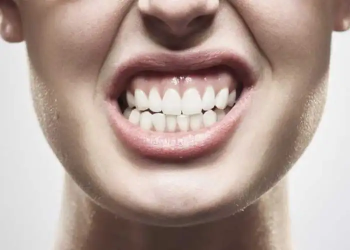 دندان قروچه(Bruxism)