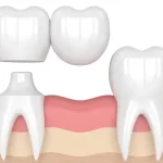 بریج دندان چیست؟