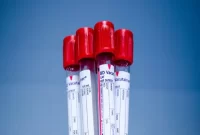 آزمایش CA-125 یا آنتی ژن سرطانی