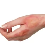 سوختگی درجه یک