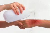 سوختگی درجه چهار | شدیدترین نوع سوختگی