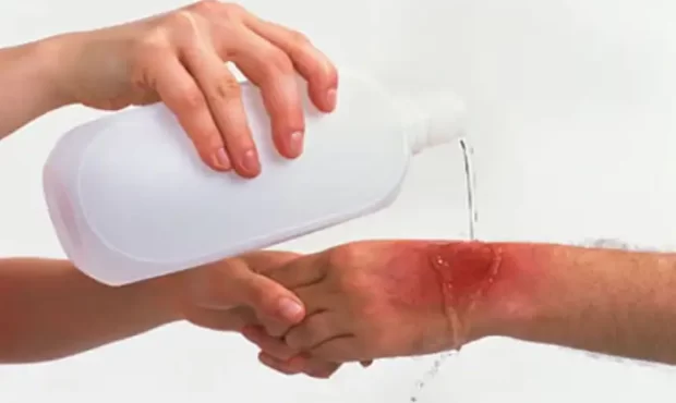 سوختگی درجه چهار شدیدترین نوع سوختگی