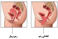 علائم افتادگی رحم