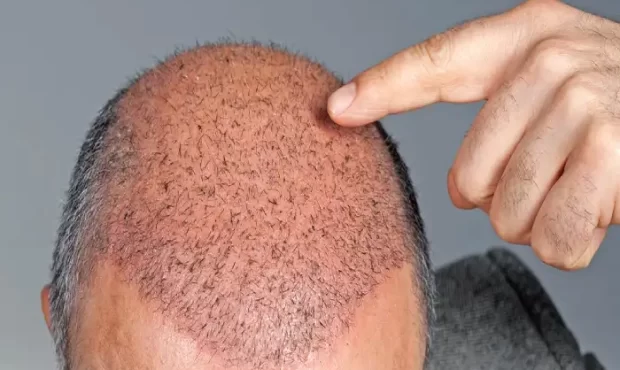 مراقبت های بعد از کاشت مو