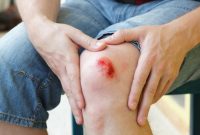 از کجا بفهمیم زخم عفونت کرده؟ علائم+ درمان