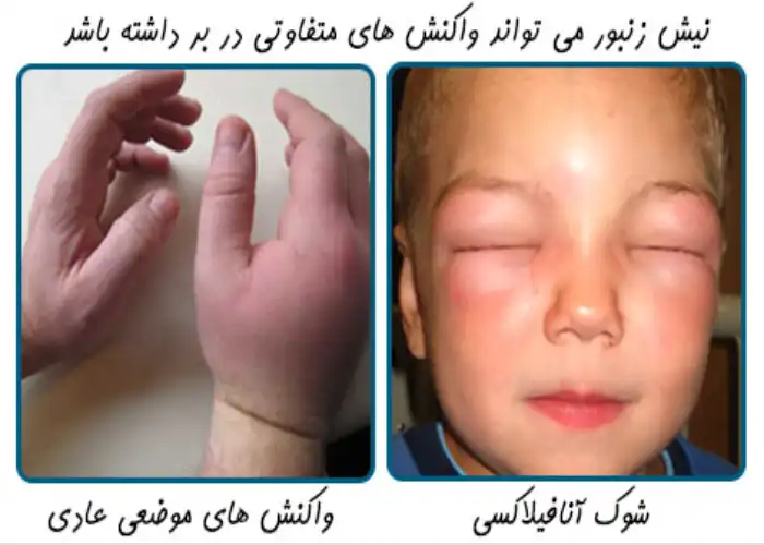 علائم حساسیت به نیش زنبور