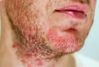 اگزمای دیشیدروتیک