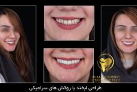 اصلاح طرح لبخند | طرح لبخند هالیوودی