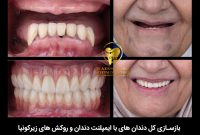 ایمپلنت تحت آرامبخشی ( سدیشن )چیست؟ Sedation Dentistry