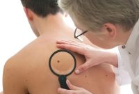بهترین دستگاه برداشتن خال و زگیل کدام است؟ + راهنمای خرید