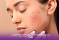 بهترین روش های آبرسانی پوست چرب و جوش دار
