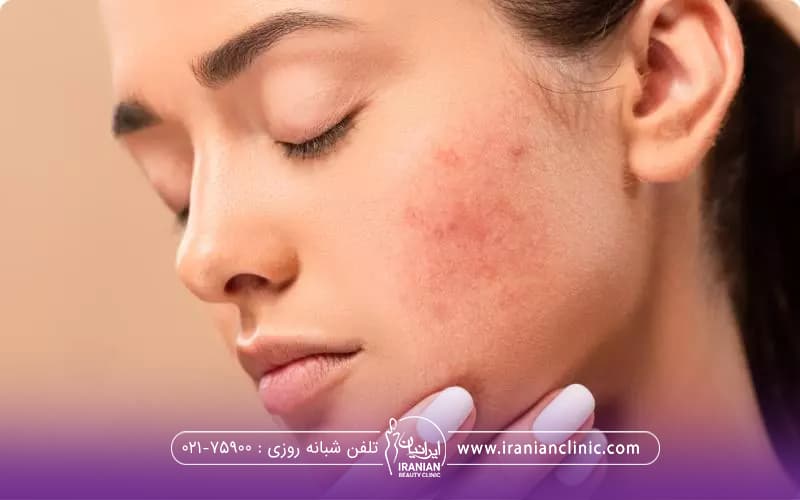 فردی که از صورت جوش دار خود ناراحت است و دستش زیر چانه اش قرار گرفته