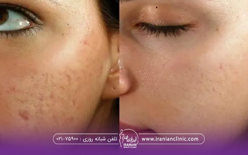 قبل و بعد فردی آبرسانی برای پوست جوش دار استفاده کرده