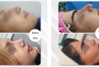 چطور بهترین نتیجه را از جراحی زیبایی بینی بگیریم؟