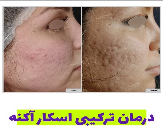 مدت‌زمان و تعداد جلسات مورد نیاز