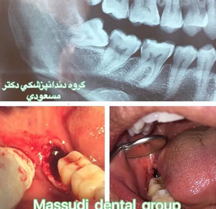 دندان عقل