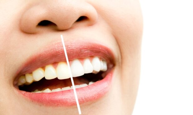 آیا بلیچینگ دندان پر شده مؤثر است؟ بررسی علمی و تجربی
