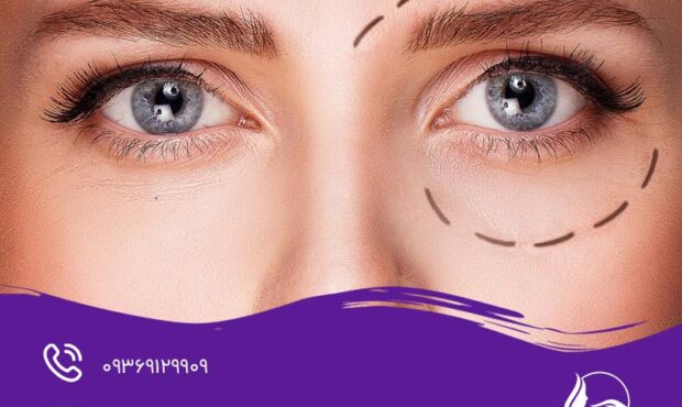 تغذیه بعد از بلفاروپلاستی: راهنمای جامع