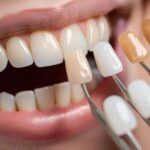 کامپوزیت ونیر چیست و آیا ارزش انجام دارد؟ بررسی دوام و عوارض