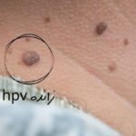 5 Home Remedies for Genital Warts