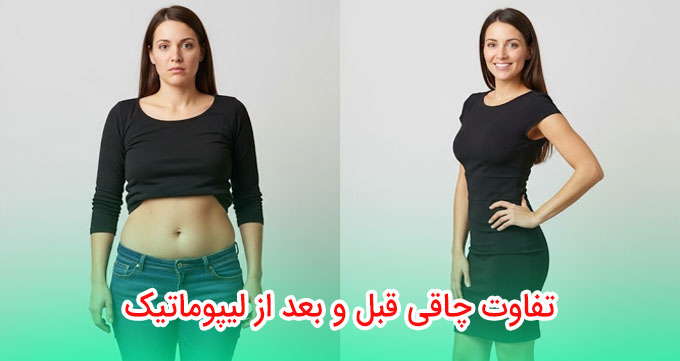تفاوت چاقی قبل و بعد از لیپوماتیک