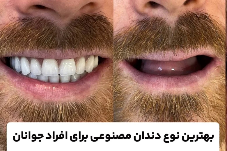 بهترین مرکز دندان مصنوعی برای افراد جوان