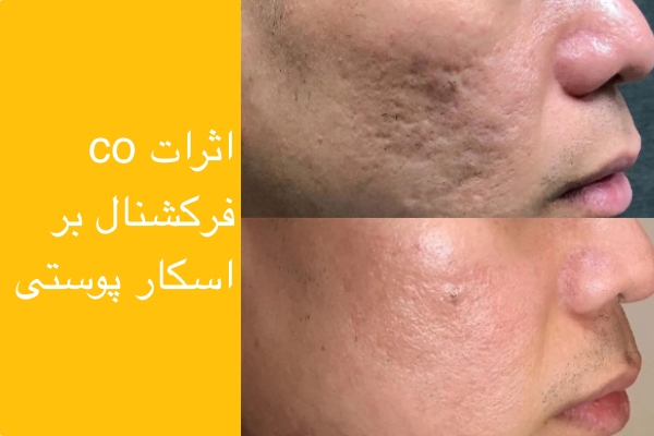 تصویر اثرات co2 فرکشنال در درمان اسکار