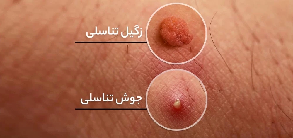 مروری بر روش‌های درمانی رایج زگیل تناسلی