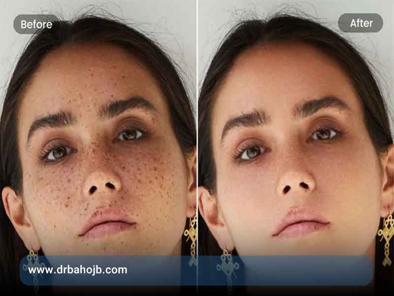 روش های از بین بردن لک صورت در خانه عکس قبل و بعد درمان لک صورت