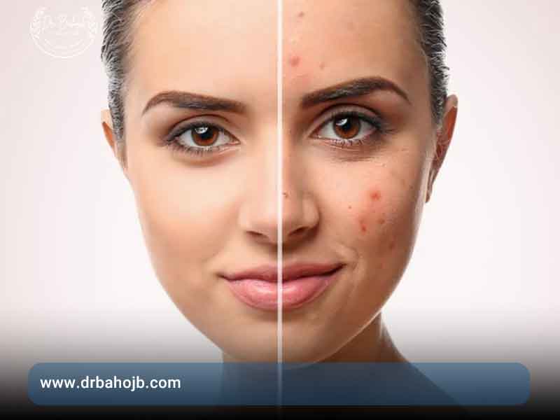 روش های از بین بردن لک صورت در خانه درمان لک صورت در کلینیک زیبایی باحج پردیس