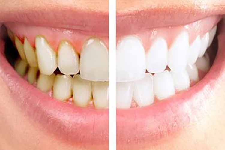 جرم گیری دندان چیست و چرا هر ۶ ماه یکبار باید انجام شود؟ هزینه جرم گیری دندان